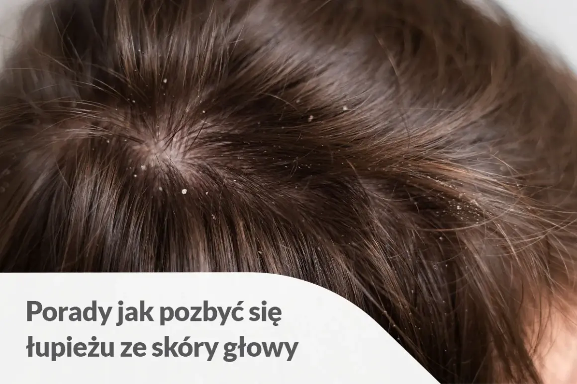 Widoczny łupież na czubku głowy, wśród ciemnych włosów. Białe płatki osiadły na skórze i włosach, tworząc nieestetyczny widok.