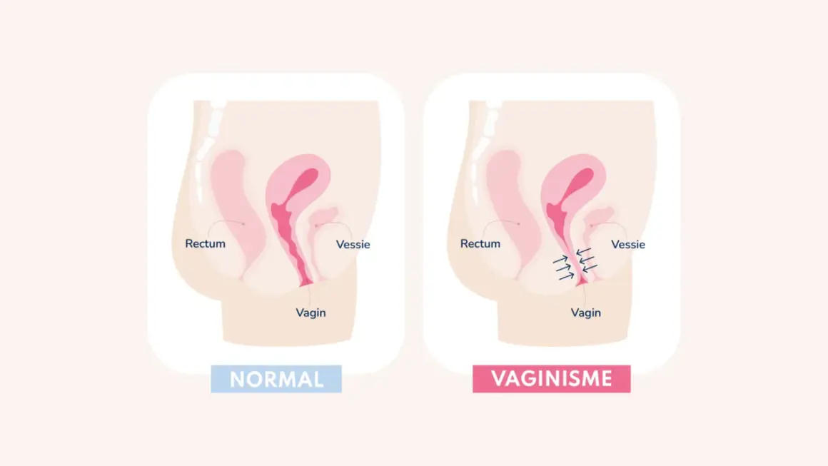 Comparaison anatomique : vagin normal et vaginisme. Le vaginisme peut causer une douleur au plancher pelvien due à une contraction involontaire.