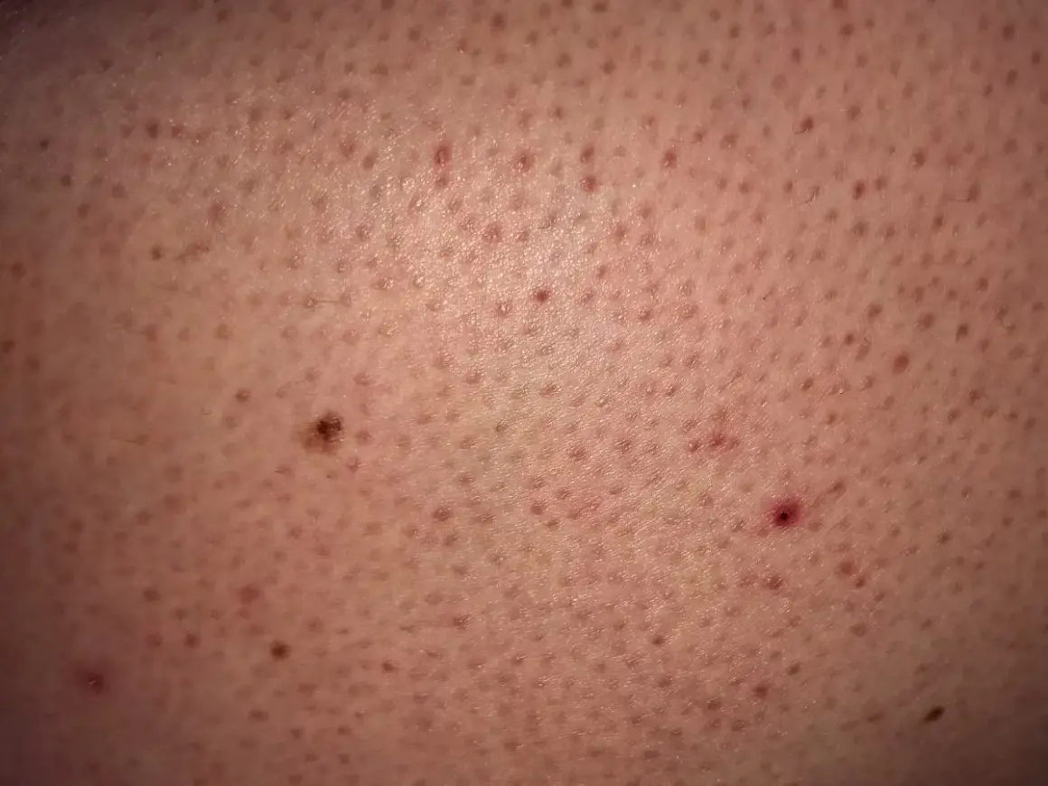Widoczne liczne drobne krostki na ramionach, niektóre zaczerwienione, tworzące teksturę skóry.