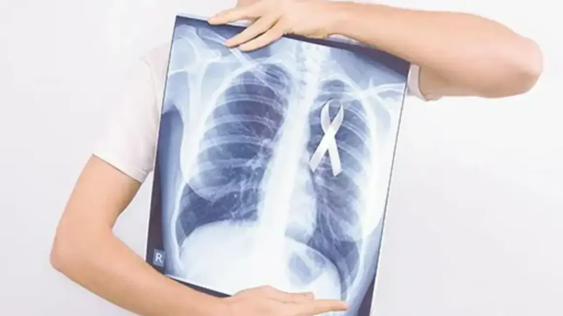 Rentgen klatki piersiowej z białą wstążką symbolizującą nadzieję na leczenie, np. pembrolizumabem.