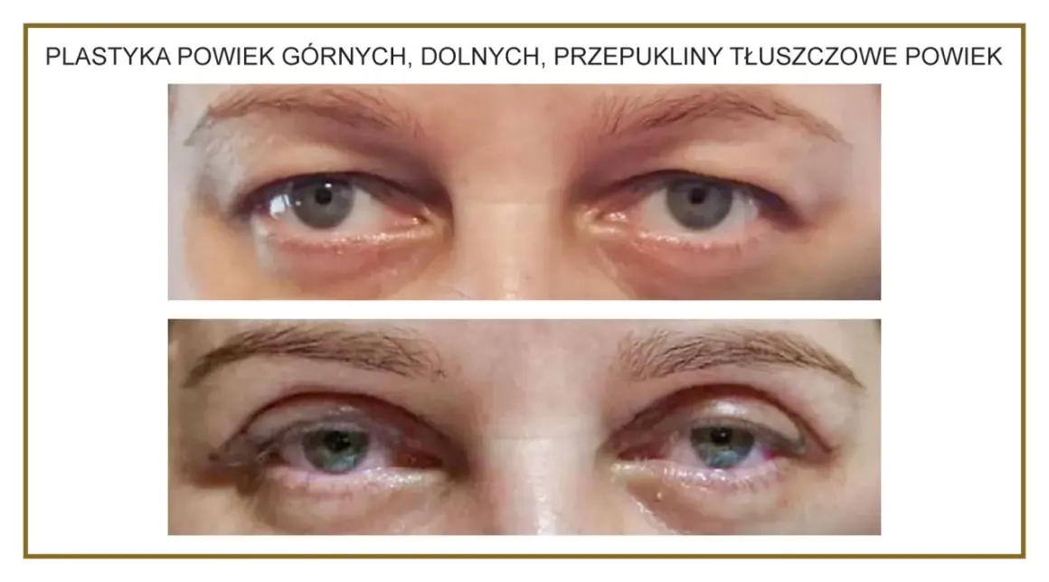 Przed i po zabiegu usunięcia przepukliny tłuszczowej powiek górnych. Widoczne zmiany w wyglądzie okolic oczu.