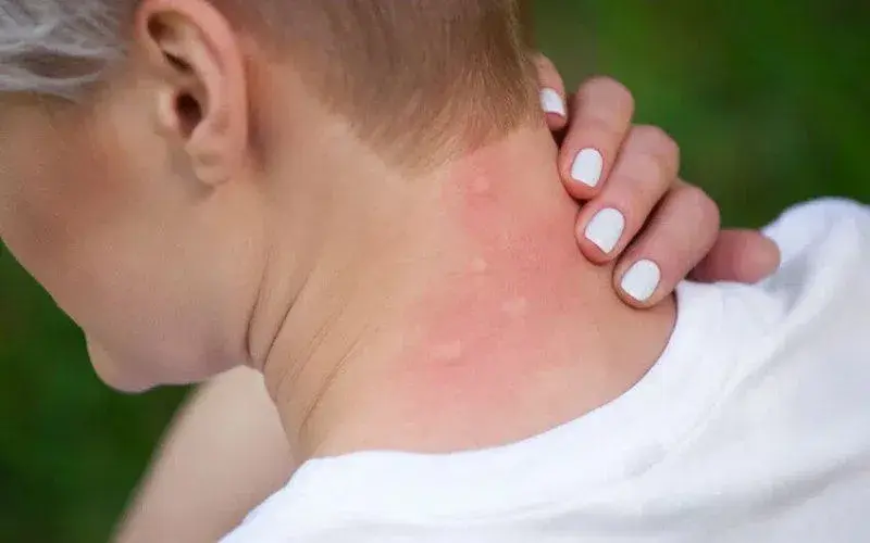 Alergia na gluten objawy skórne: jak je rozpoznać i leczyć