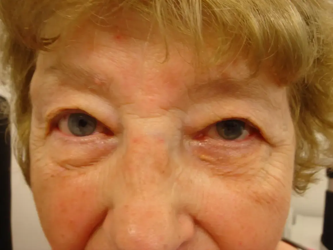 Nahaufnahme eines Gesichts mit Falten um die Augen. Ein gelblicher Fleck ist am rechten Unterlid sichtbar, ein mögliches Symptom eines Aderhautmelanoms.