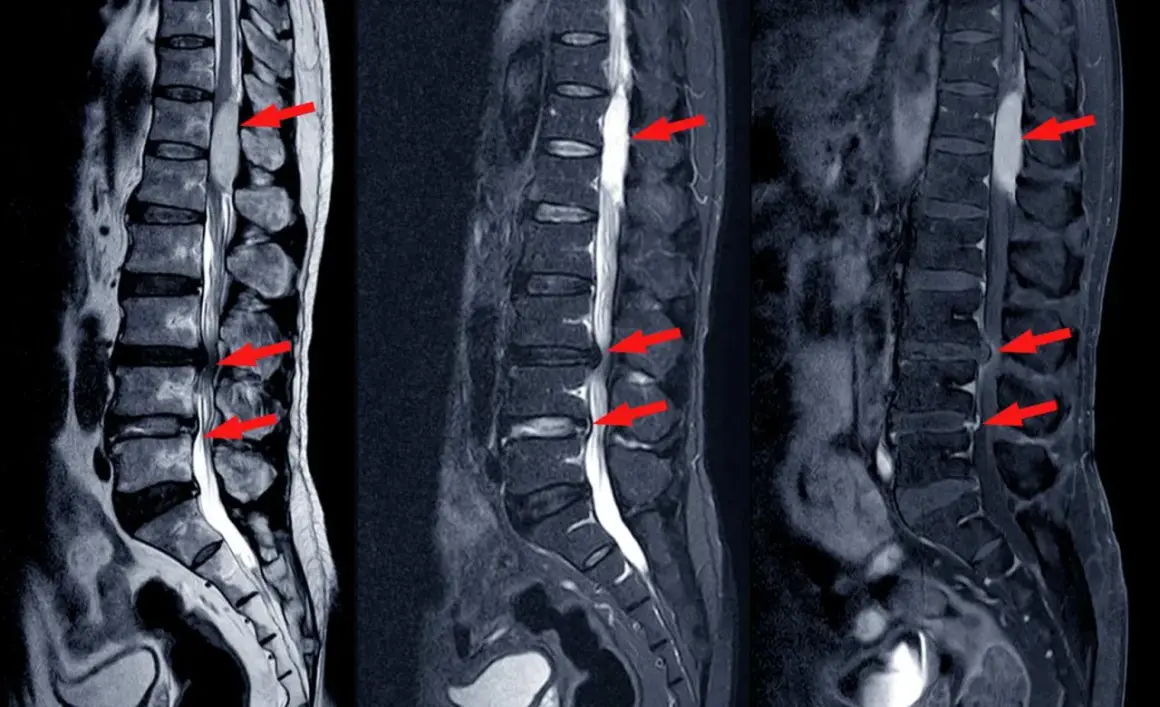Obraz MRI kręgosłupa lędźwiowego z widocznymi zwężeniami kanału kręgowego (stenoza kanału kręgowego) zaznaczonymi czerwonymi strzałkami.
