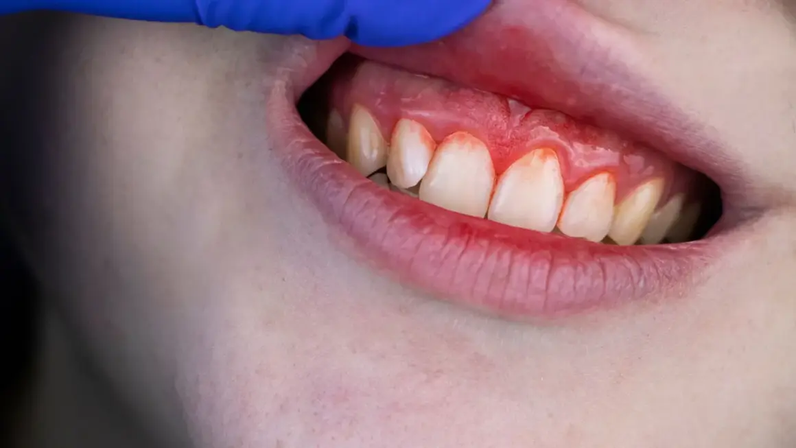 Encías inflamadas y rojas, indicando la necesidad de un tratamiento para encías sangrantes.