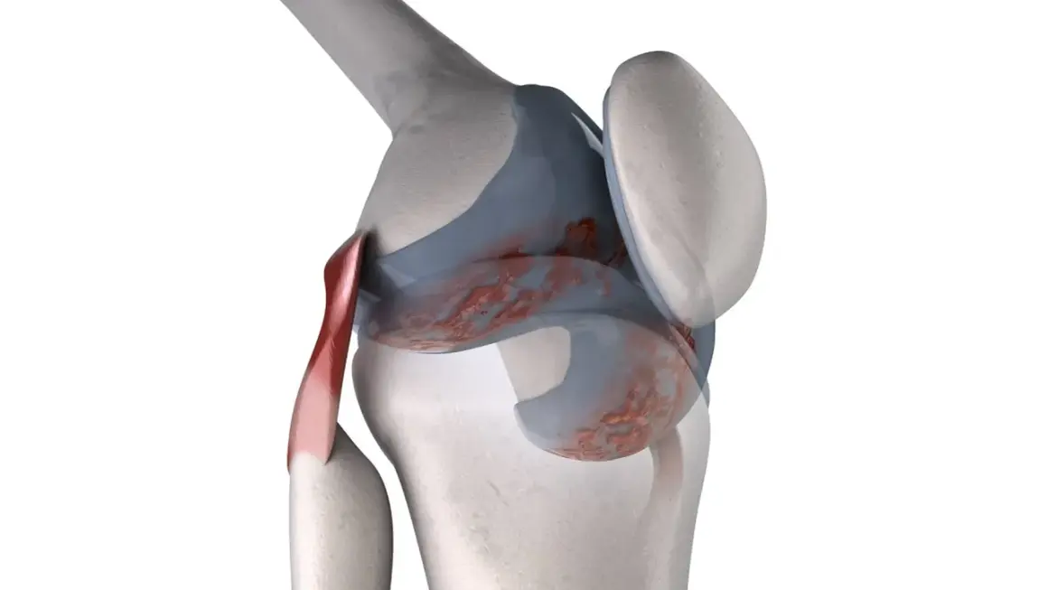 Dettaglio anatomico del ginocchio con lesioni cartilaginee e tendine rosso. Il ginocchio che scricchiola quando lo stendo potrebbe essere causato da questo.