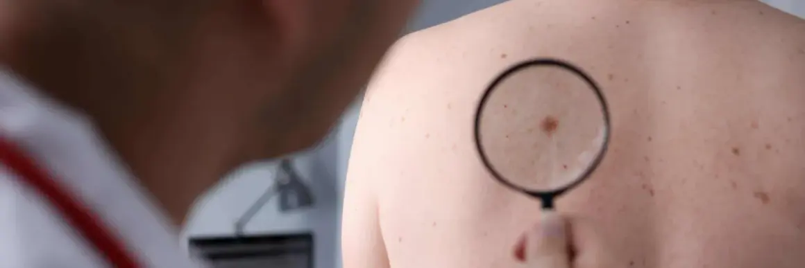 Dermatolog bada znamiona barwnikowe na plecach pacjenta za pomocą lupy.