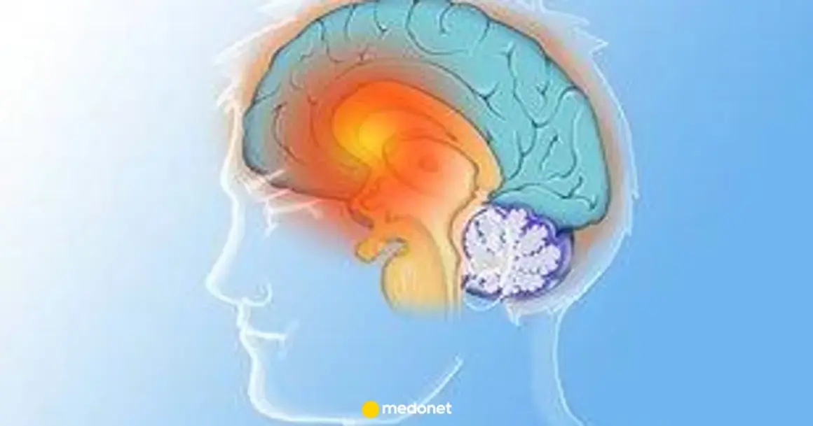 Ilustracja mózgu z zaznaczonymi obszarami, sugerującymi problemy neurologiczne, takie jak pląsawica.