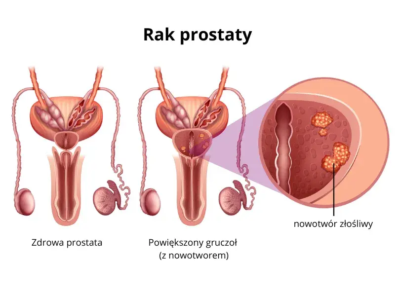Czy rak prostaty daje przerzuty? Poznaj niebezpieczeństwa i objawy