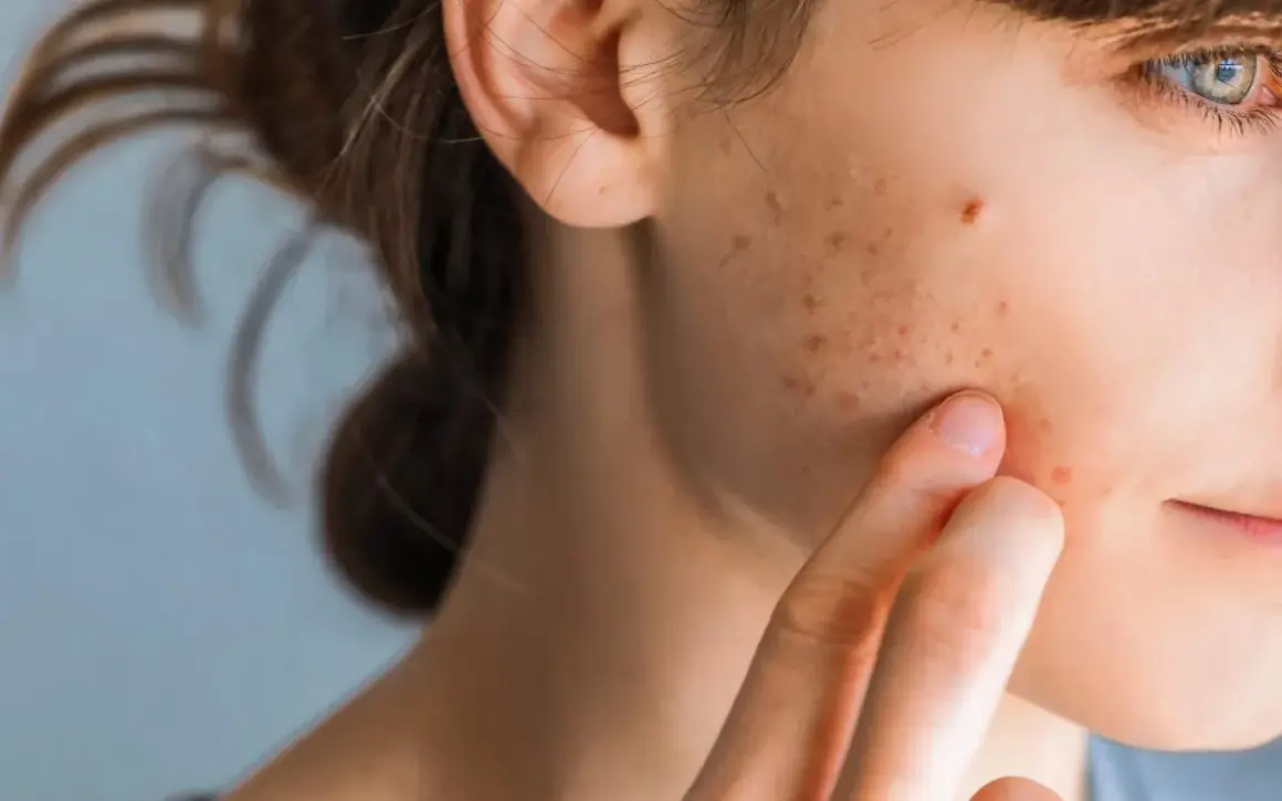 Nahaufnahme einer jungen Frau, die mit dem Finger über ihre Wange streicht, auf der rote und braune Flecken sichtbar sind, die auf Stresspickel hindeuten.
