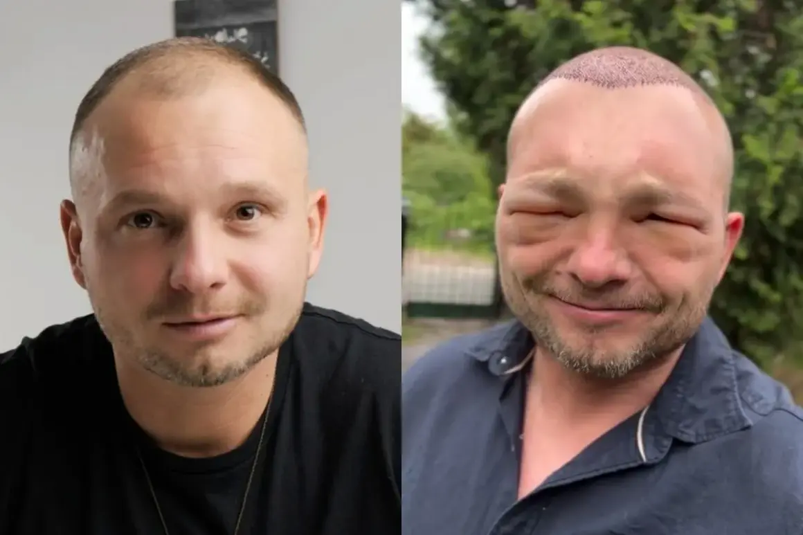 Mężczyzna po przeszczepie twarzy, z opuchniętymi powiekami i widocznymi śladami zabiegu na głowie.