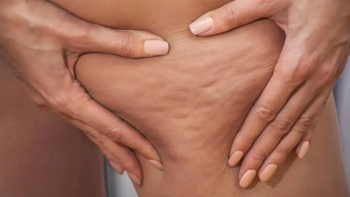 Hände greifen in die Haut und zeigen die typischen Dellen. So entsteht Cellulite.