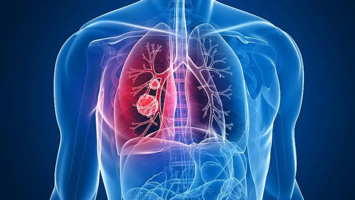 Menschliche Lunge mit einem roten Tumor, der Lungenkrebs darstellt. Das Alter spielt eine Rolle bei der Entstehung.