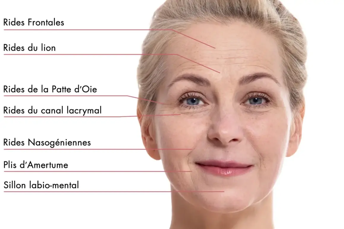 Visage d'une femme montrant les rides frontales, du lion, pattes d'oie, nasogéniennes, plis d'amertume et sillon labio-mental.