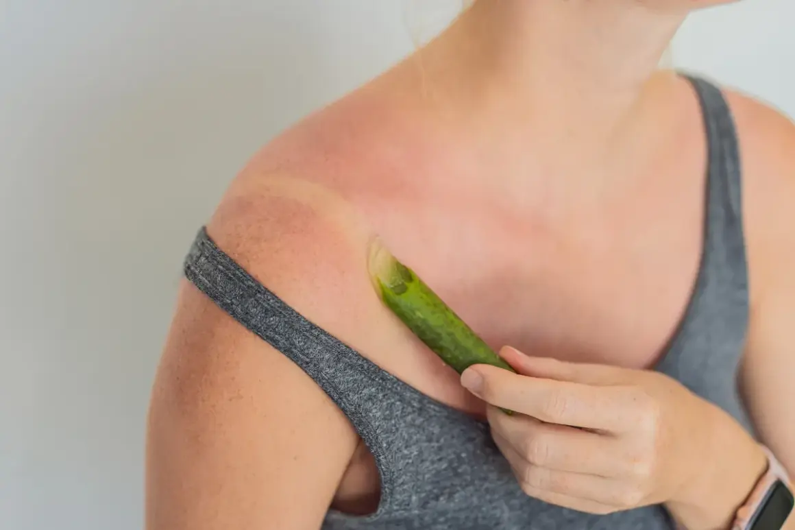 Donna applica gel di aloe vera su una scottatura solare, sfruttando i benefici per la pelle.