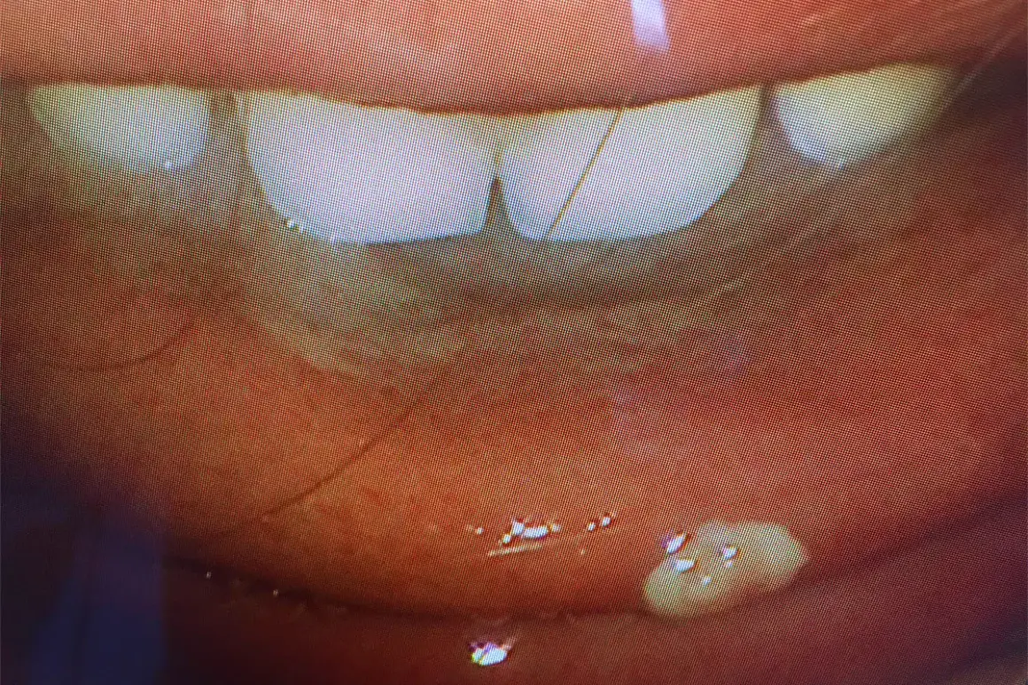 Nahaufnahme der Lippen und Zähne. Kleine, weiße Flecken auf der Innenseite der Lippe, die auf eine HPV-Infektion im Mund hindeuten könnten.