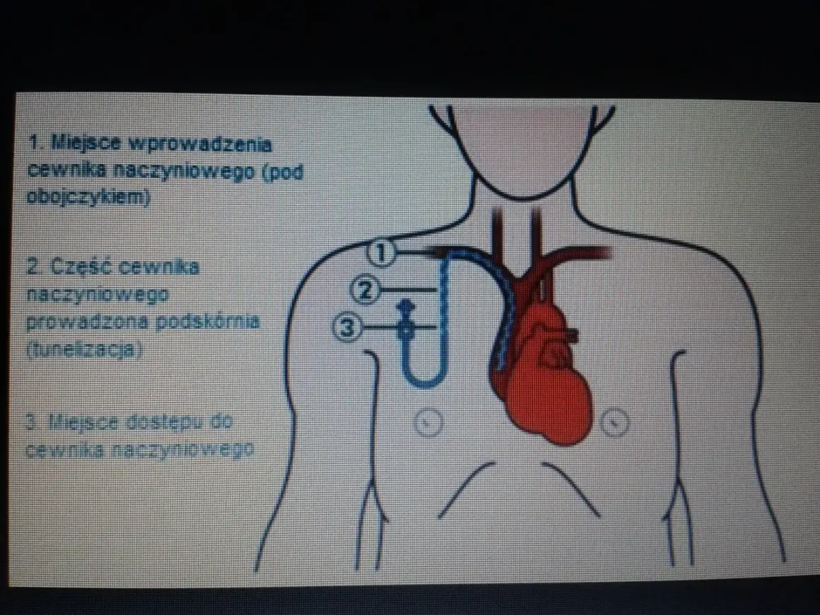 Schemat przedstawia umiejscowienie portu naczyniowego. Cewnik wprowadzany jest pod obojczykiem, prowadzony podskórnie, a następnie trafia do naczynia.