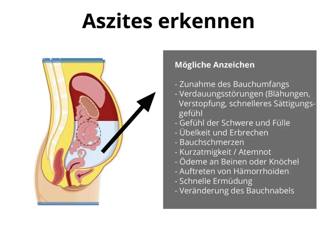 Illustration zeigt Bauchraum mit Flüssigkeitsansammlung. Symptome wie Bauchumfangszunahme und Völlegefühl deuten auf Wasser im Bauch hin.