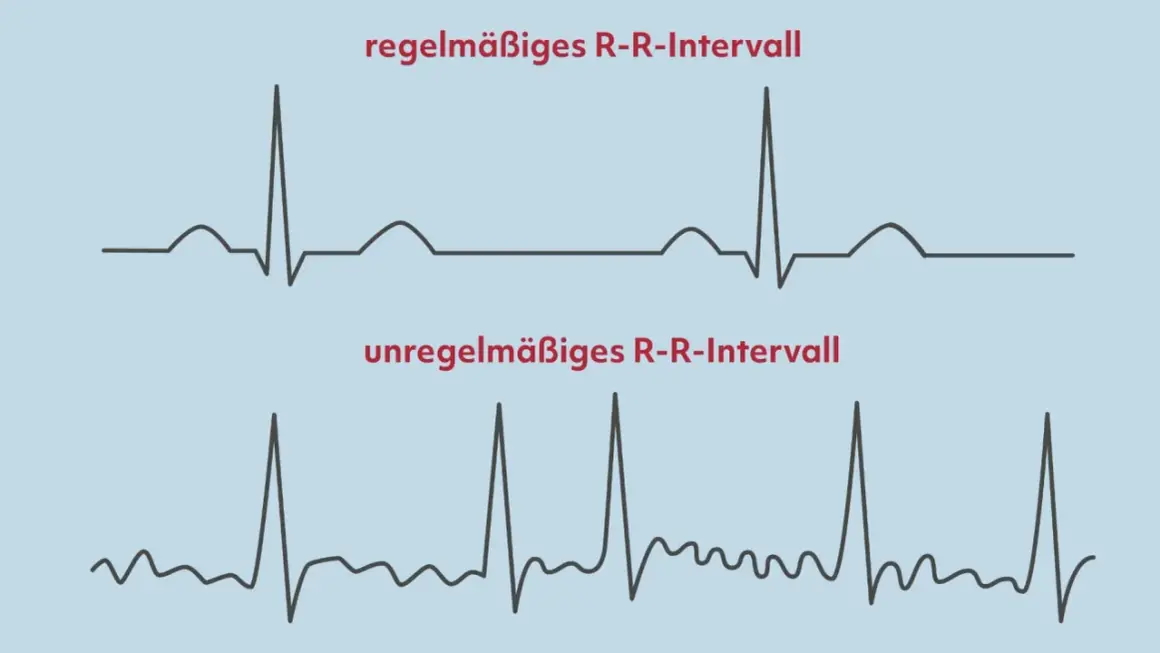Oben: Regelmäßiges R-R-Intervall. Unten: Unregelmäßiges R-R-Intervall, ein mögliches Anzeichen für Herzkammerflimmern.
