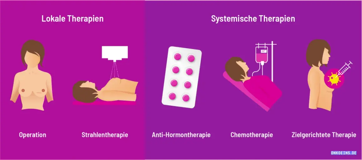 Illustration zeigt lokale und systemische Therapien bei Brustkrebs: Operation, Strahlentherapie, Hormontherapie, Chemotherapie, zielgerichtete Therapie.