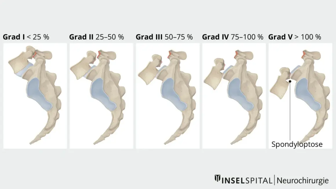 Illustrationen zeigen fünf Grade der Spondyloptose, von Grad I (<25%) bis Grad V (>100%), die den **Meyerding Grad 1 Behinderungsgrad** und weitere Stufen darstellen.