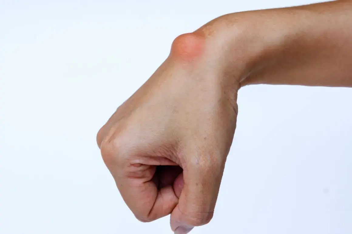 Polso con cisti da sforzo mano, un rigonfiamento visibile sulla parte superiore del polso, indice di un problema legato all'uso eccessivo.