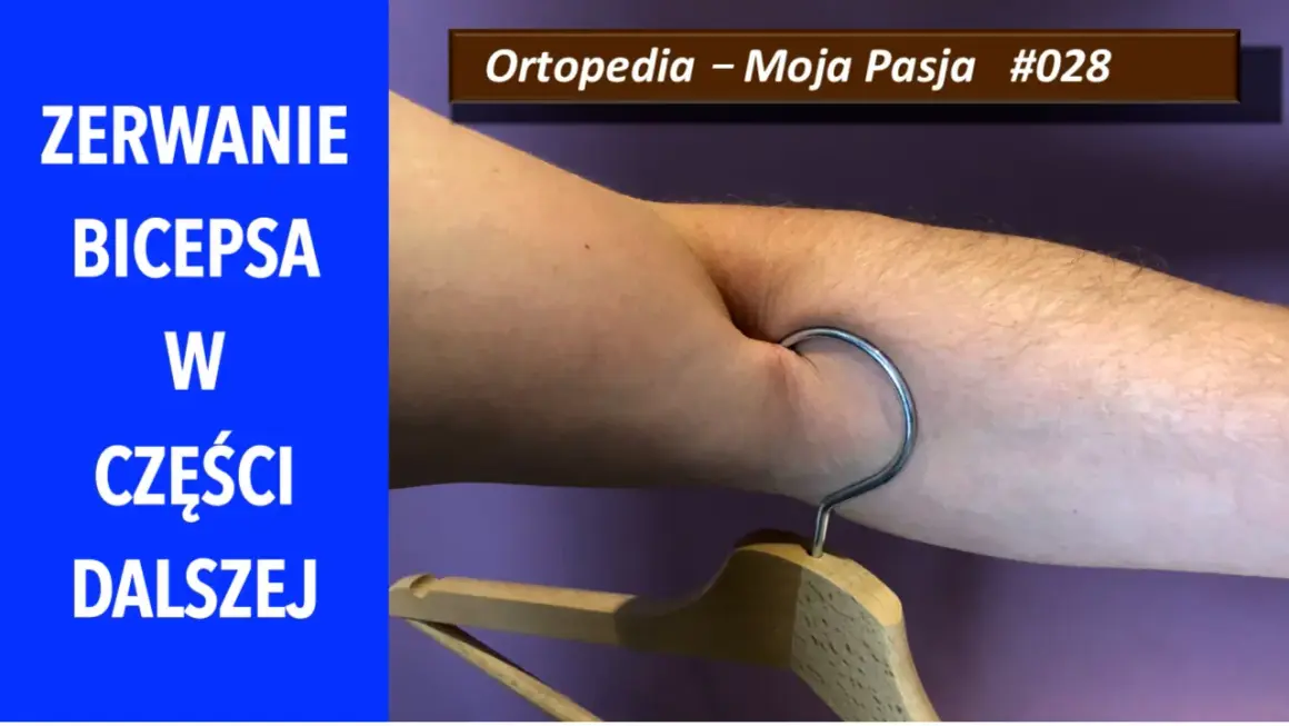 ZOBACZ objawy zerwania bicepsa w części dalszej. Na zdjęciu widać zgięte ramię z wieszakiem zaczepionym o skórę.