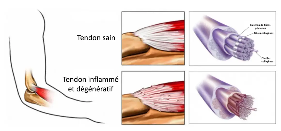 Comparaison d'un tendon sain et d'un tendon inflammé, montrant les fibres déchirées typiques du tennis elbow.