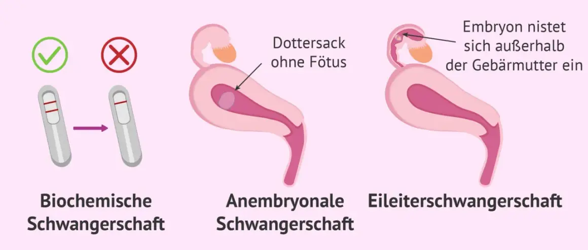 Anzeichen für eine Fehlgeburt: Biochemische Schwangerschaft, Dottersack ohne Fötus, Embryo nistet sich außerhalb der Gebärmutter ein.