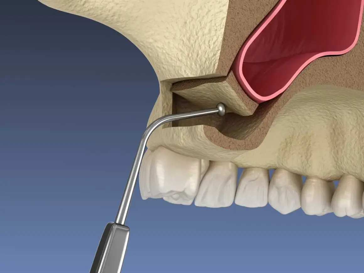 Ilustración de elevación de seno maxilar, mostrando el instrumento dental y la anatomía ósea.