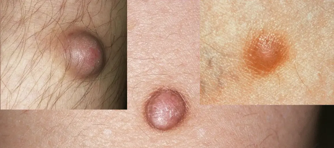 Nahaufnahme von Hautveränderungen, die auf fibrose Hautbilder hinweisen. Kleine, erhabene Knötchen auf der Haut.