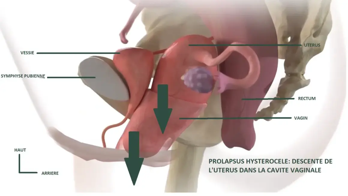 Illustration anatomique montrant le prolapsus utérin, une descente de l'utérus causant une fatigue pelvienne. La vessie et le rectum sont aussi visibles.