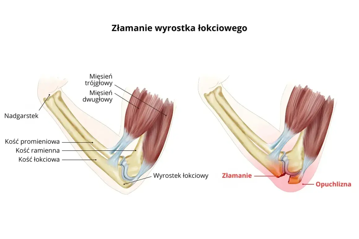 Ilustracja pokazuje złamanie wyrostka łokciowego, z zaznaczoną opuchlizną i miejscem złamania.