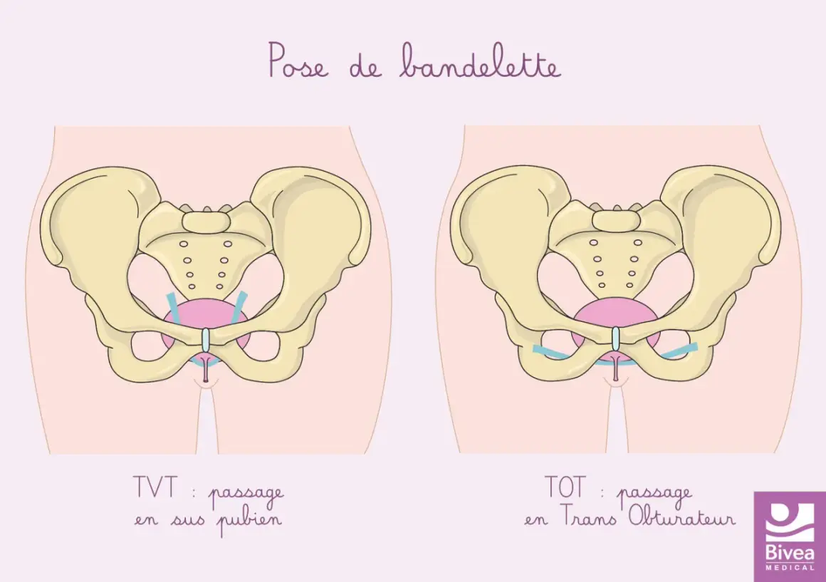 Schéma comparant deux techniques de pose de bandelette pour l'incontinence à l'effort : TVT (passage sus-pubien) et TOT (passage transobturateur).