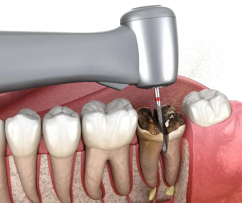 Ekstrakcja zęba z ropniem: Czy to możliwe? Kiedy dentysta usunie ząb?
