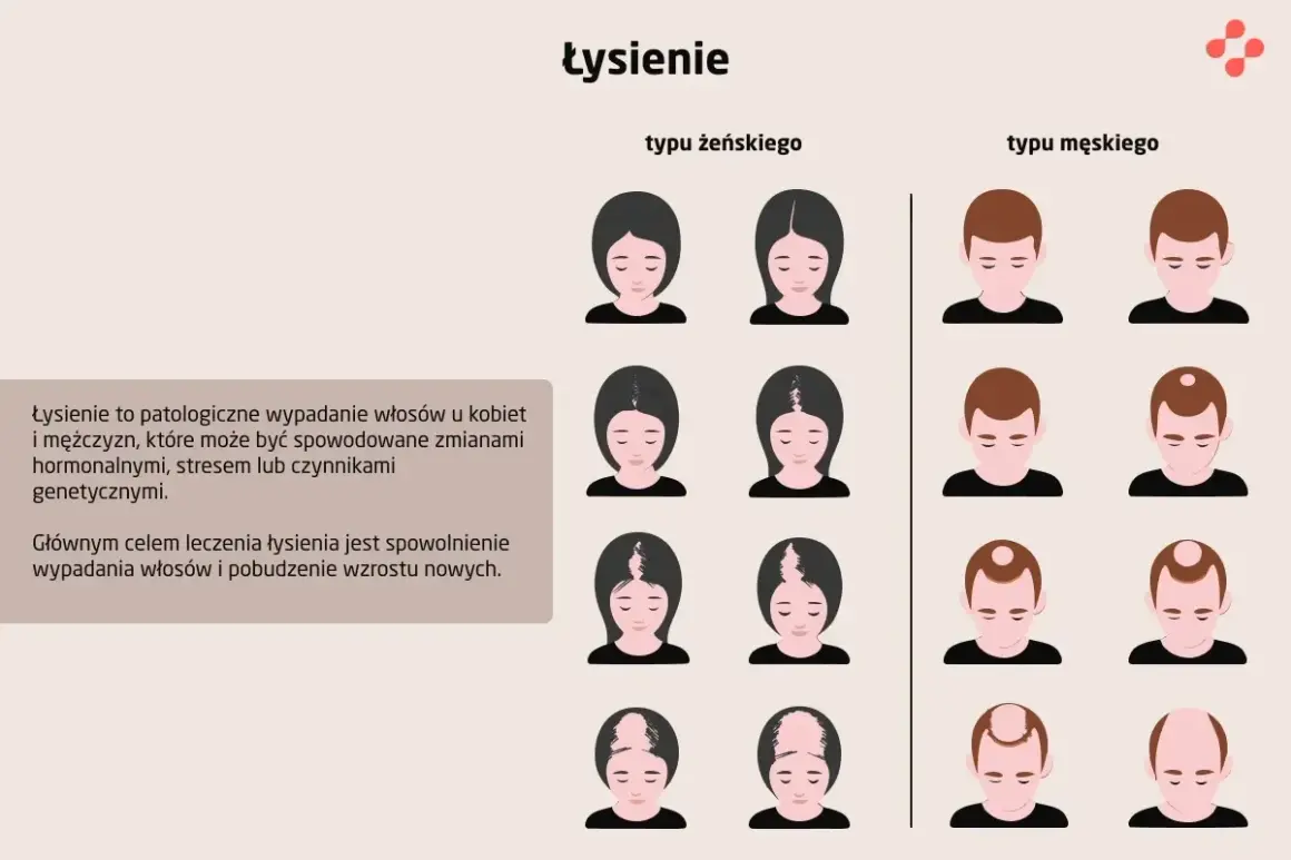 Ilustracja pokazuje różne rodzaje łysienia u kobiet i mężczyzn, od początkowych etapów po zaawansowane.