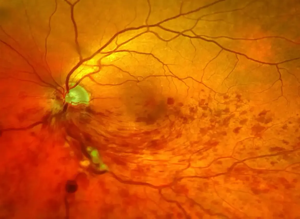 Nahaufnahme des Augenhintergrunds mit Anzeichen eines Schlaganfalls im Auge. Blutgefäße sind sichtbar, einige Bereiche sind verfärbt.