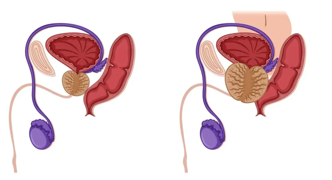 Schéma comparatif du système urinaire masculin. La prostate agrandie peut causer une fuite urinaire après grattage.
