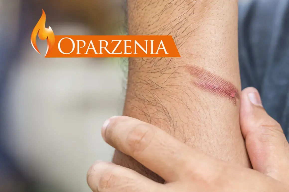 Oparzenia na przedramieniu. Zobacz, co na oparzenia pomoże.