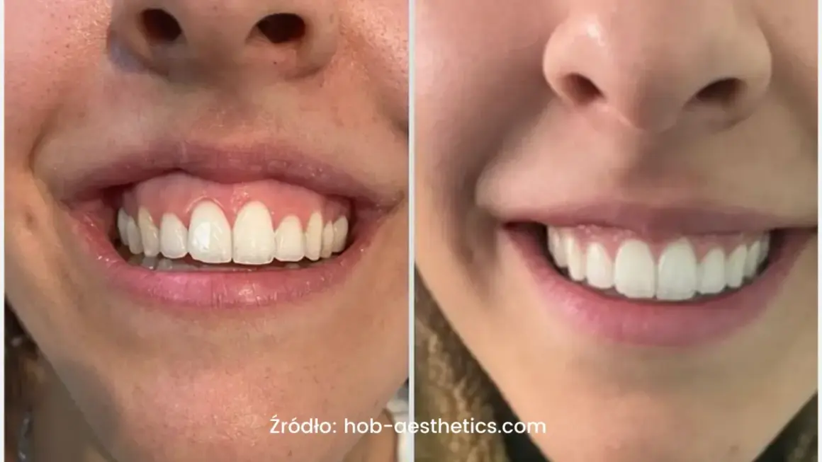 Uśmiech przed i po zabiegu botoksu na gummy smile. Widoczna różnica w odsłanianiu dziąseł.