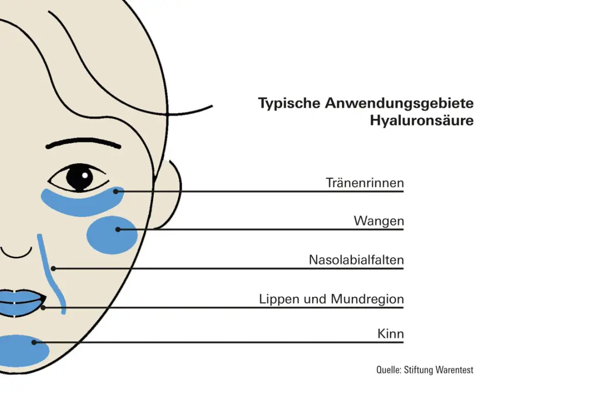 Schema zeigt typische Anwendungsgebiete für Hyaluron in der Haut: Tränenrinnen, Wangen, Nasolabialfalten, Lippenregion und Kinn.