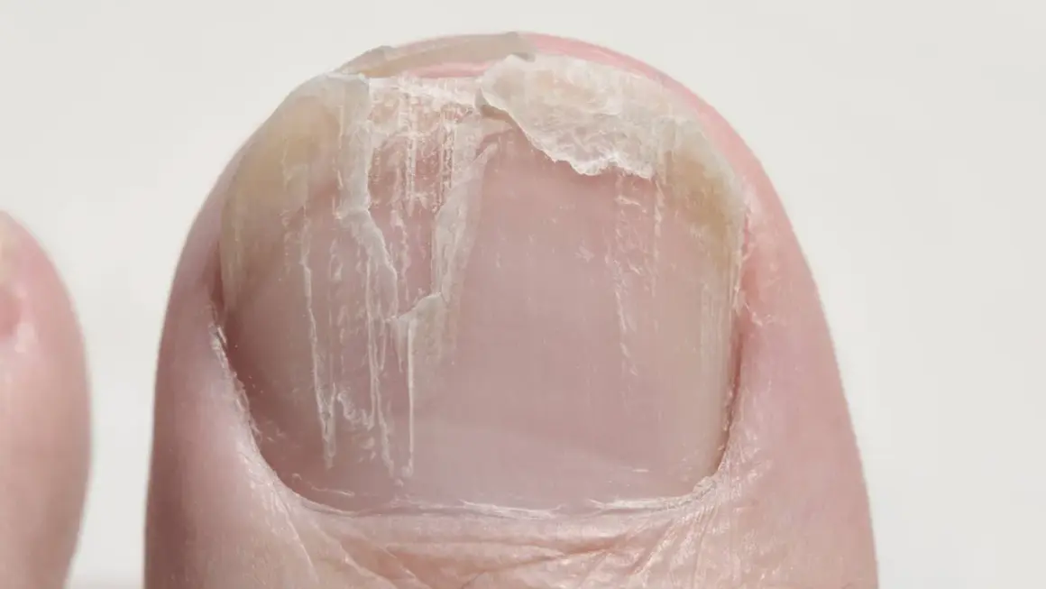Nahaufnahme eines Zehennagels mit querrillen und abgebrochenen Stellen.