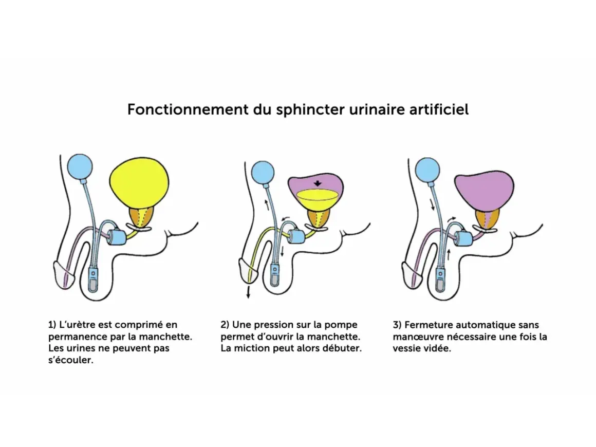 Schéma du fonctionnement d'un sphincter urinaire artificiel, une solution pour les fuites urinaires après prostatectomie totale.