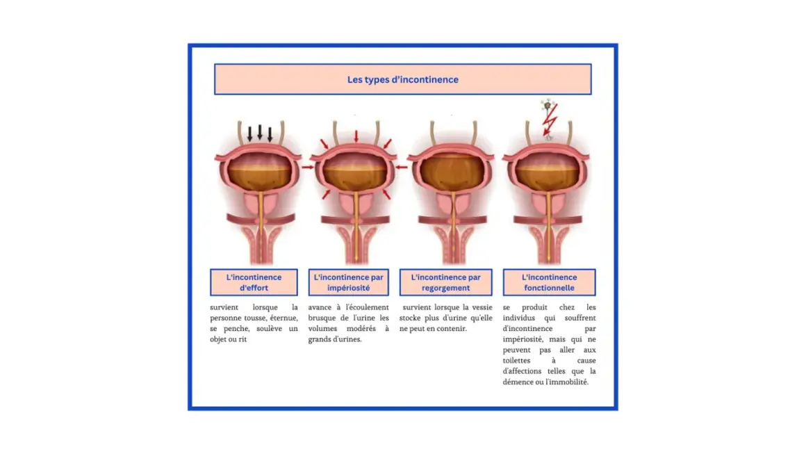 Illustration des types d'incontinence urinaire. L'incontinence d'effort survient quand on tousse ou éternue, un peu comme quand j'éternue je fais pipi.