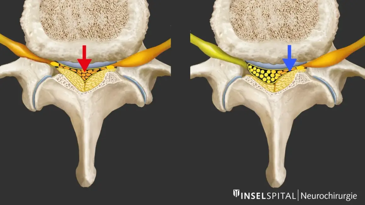 Vergleich: Spinalkanalstenose LWS mit Druck (rot) vs. Entlastung (blau). Die Darstellung zeigt, wie sich die Nervenwurzeln bei einer Spinalkanalstenose LWS verhalten.
