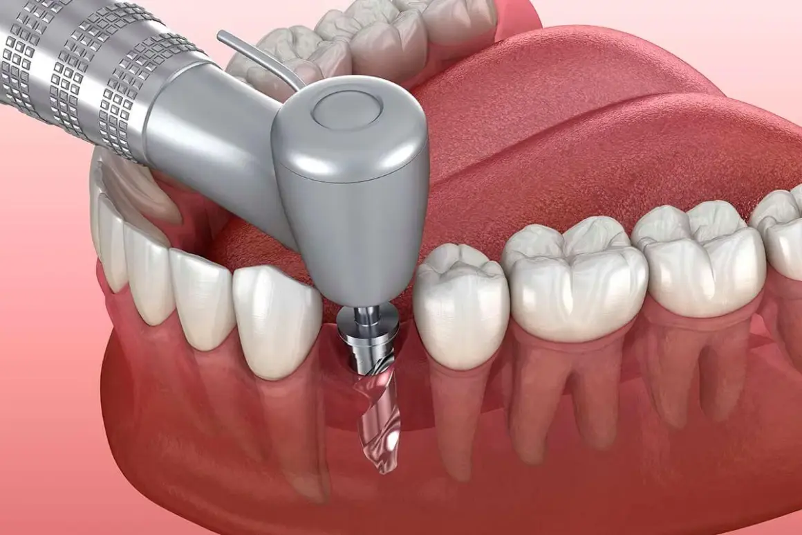 Procedimiento dental para colocar un implante. Conocer el coste de un implante dental es clave para tu salud bucal.