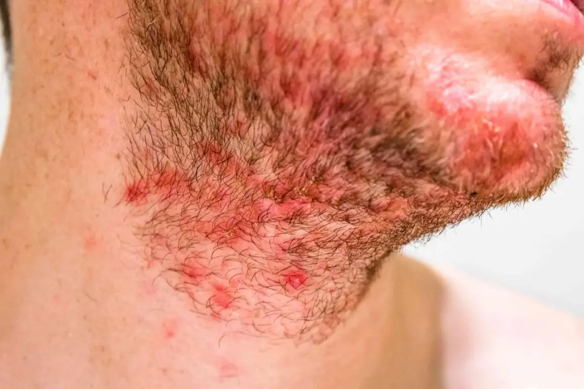 Gros plan sur la barbe d'un homme, montrant une irritation et une rougeur au cou, avec quelques boutons visibles.