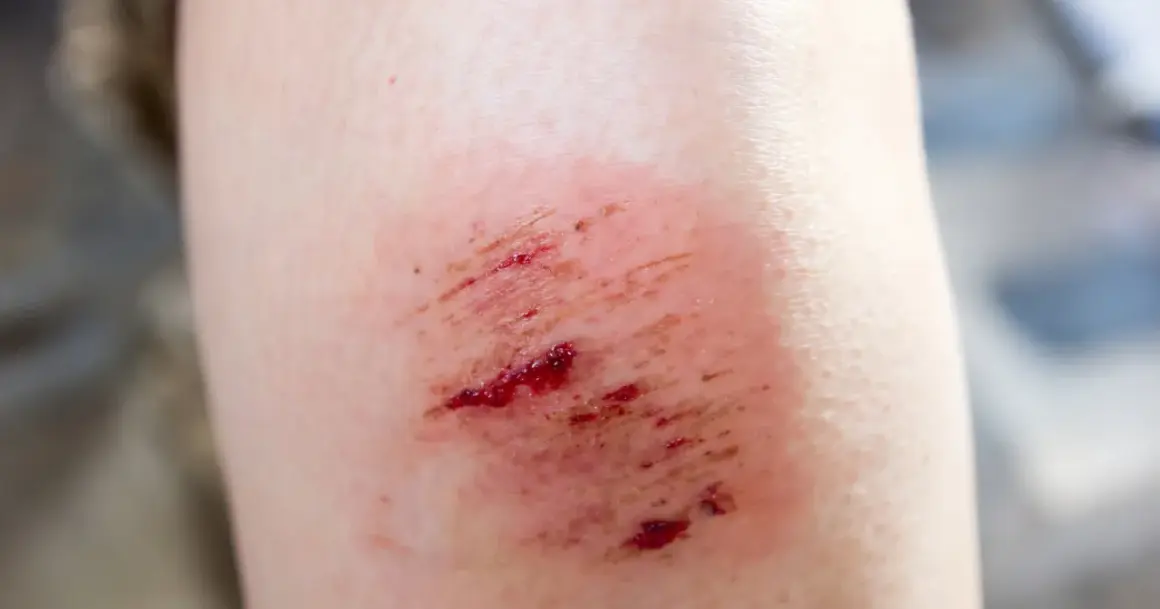 Otarte otarte kolano, zaczerwienione i lekko krwawiące. Potrzebuje **oktaseptal** do dezynfekcji.