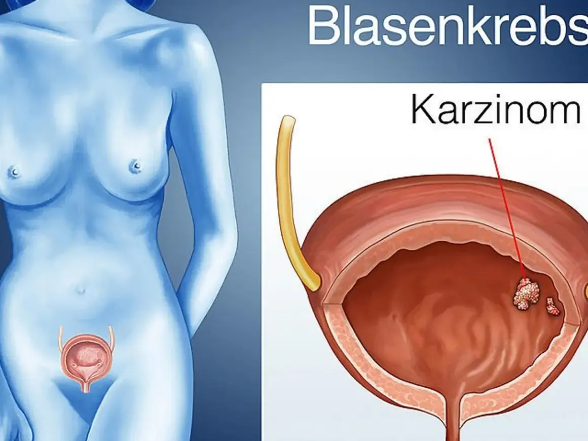 Illustration zeigt eine weibliche Figur und eine Blase mit einem Karzinom. Mögliche blasenkrebs symptome werden hier visuell dargestellt.