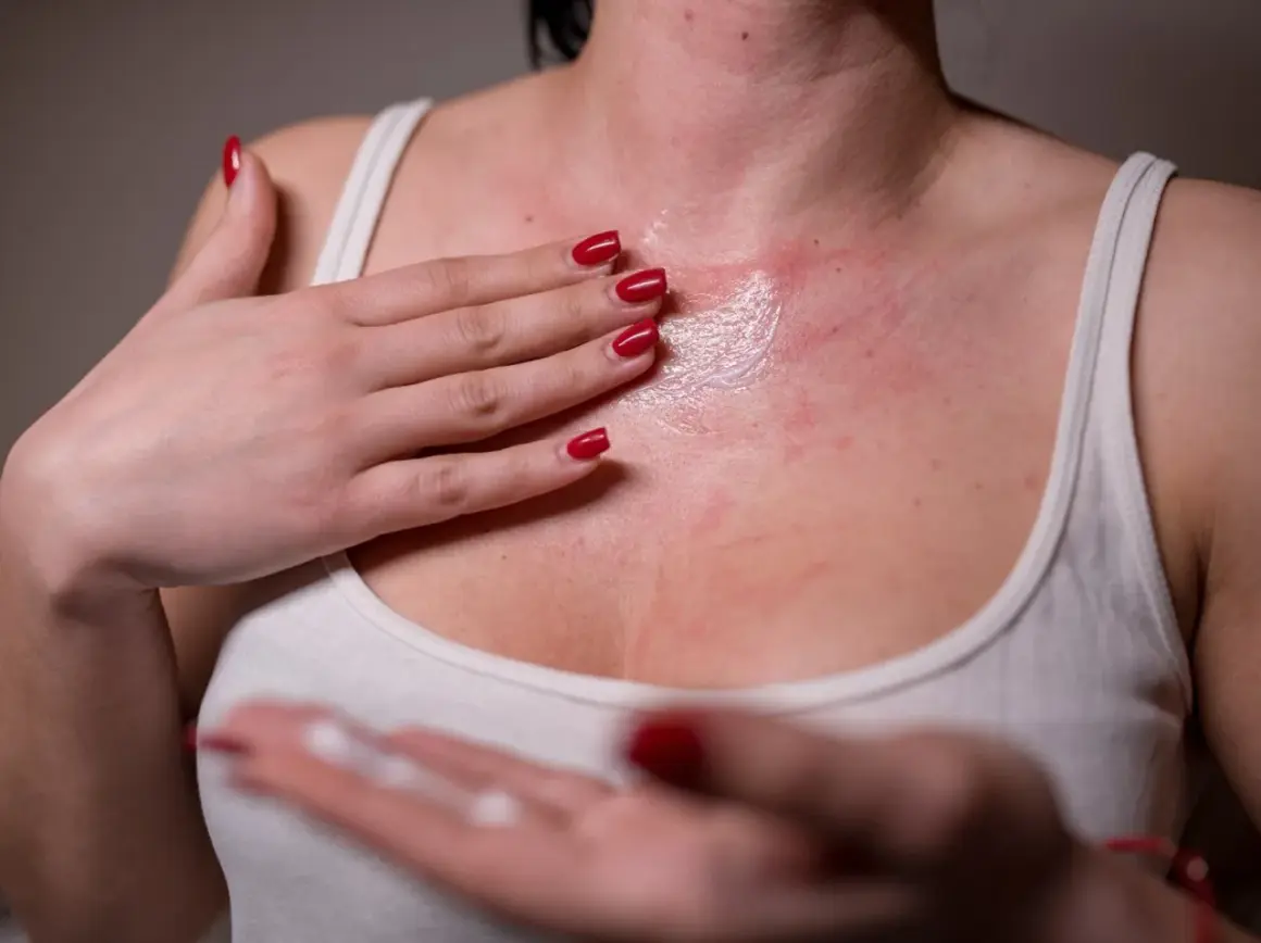 Rote Hautstellen und Juckreiz, mögliche Geraniol Allergie Symptome. Eine Hand trägt eine Salbe auf.